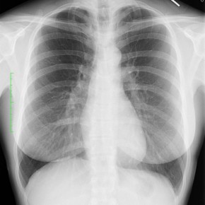 TB chronicles - Chest X-Ray, 2 Views