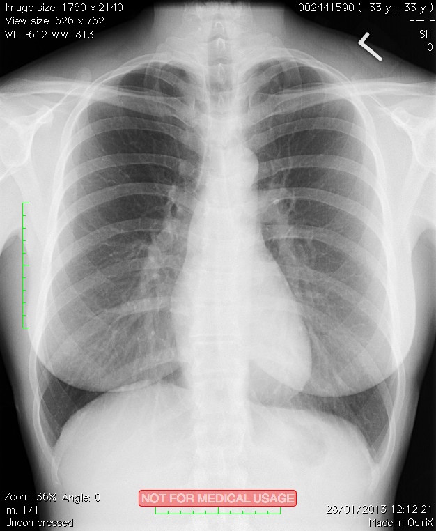 chest_xray