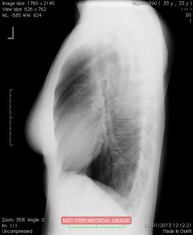 chest_xray2